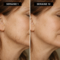 Halo™ — IPL Ménopause