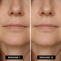 Halo™ — IPL Ménopause